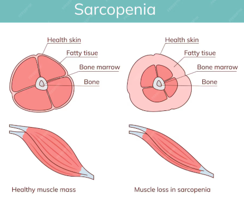 SARCOPENIA