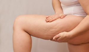 a woman with cellulite