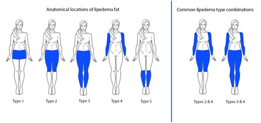 lipedema 4