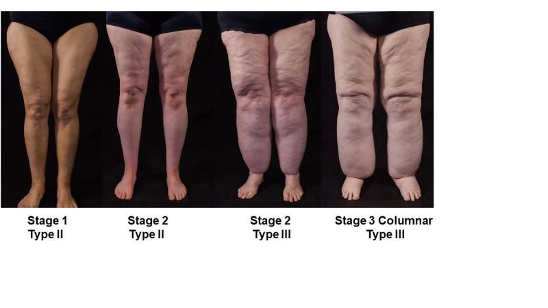 lipedema stage